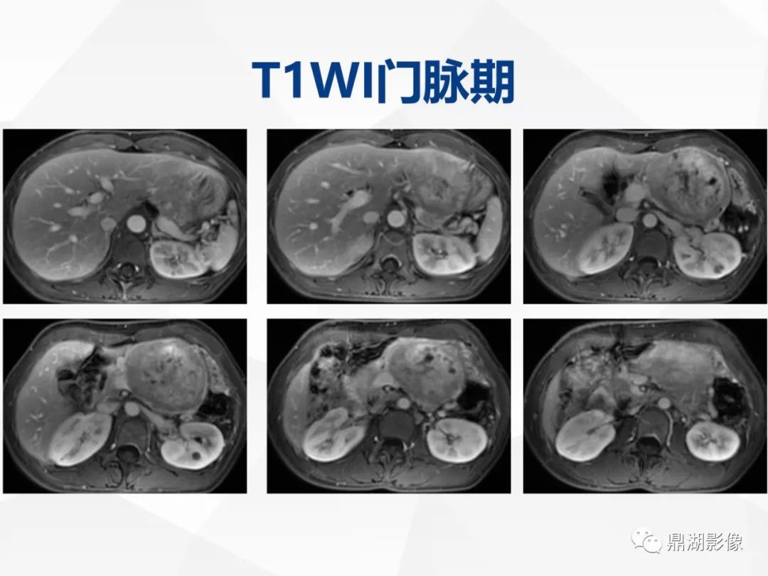 影像PPT - 【病例】胰腺神经内分泌肿瘤不典型病例1例CT及MR影像-12