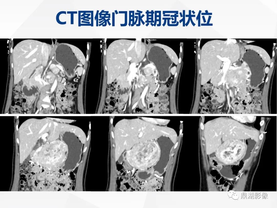 影像PPT - 【病例】胰腺神经内分泌肿瘤不典型病例1例CT及MR影像-7