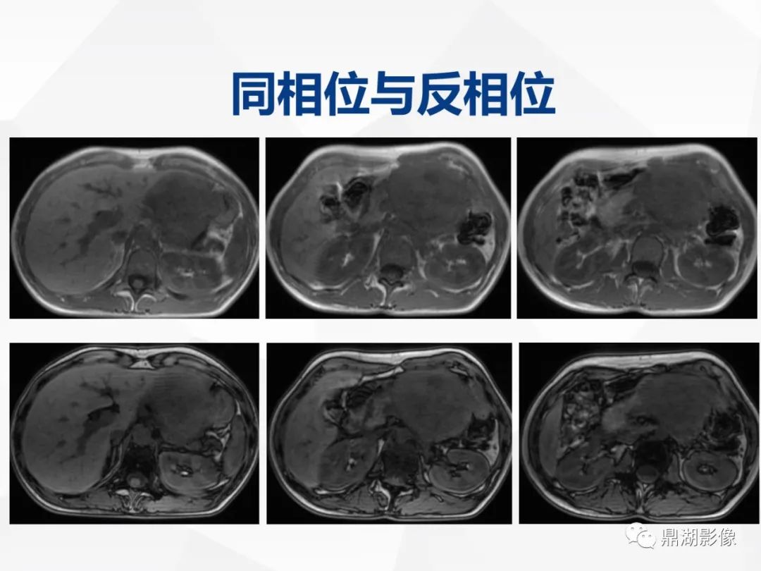影像PPT - 【病例】胰腺神经内分泌肿瘤不典型病例1例CT及MR影像-15