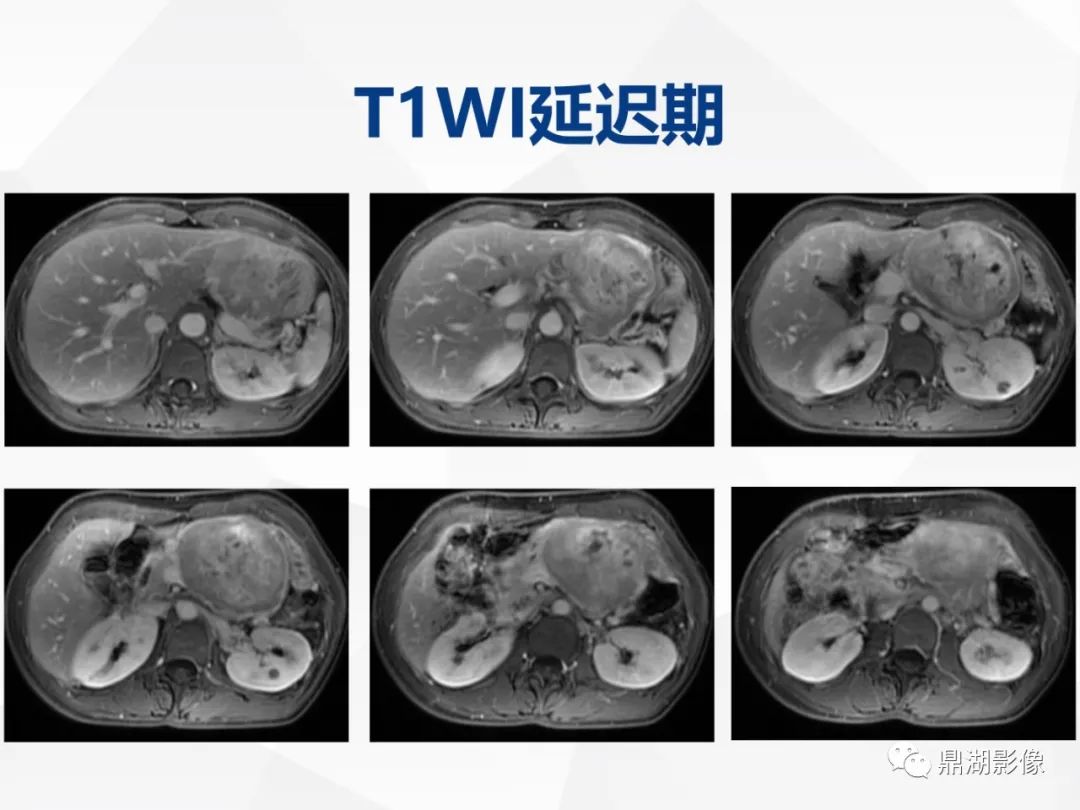 影像PPT - 【病例】胰腺神经内分泌肿瘤不典型病例1例CT及MR影像-13