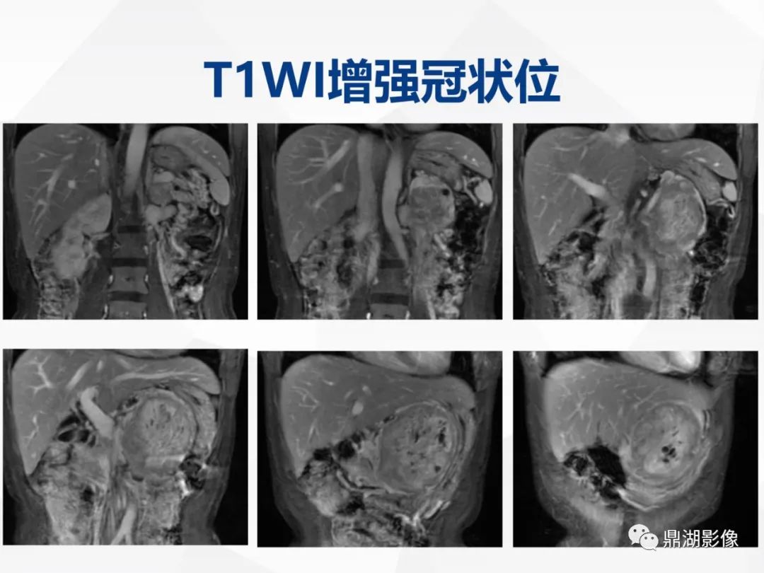 影像PPT - 【病例】胰腺神经内分泌肿瘤不典型病例1例CT及MR影像-14