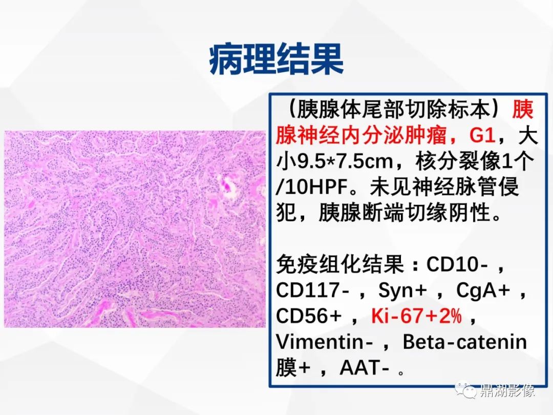 影像PPT - 【病例】胰腺神经内分泌肿瘤不典型病例1例CT及MR影像-18