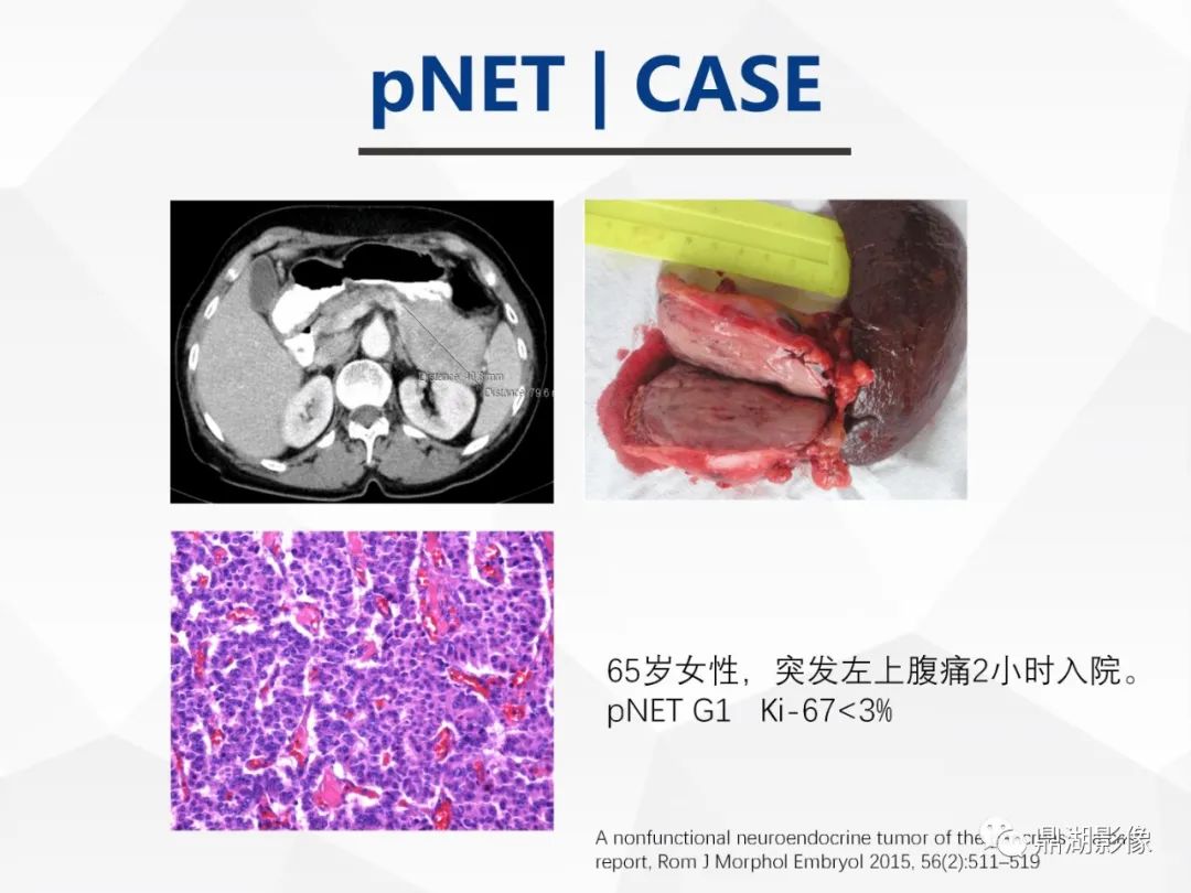 影像PPT - 【病例】胰腺神经内分泌肿瘤不典型病例1例CT及MR影像-28