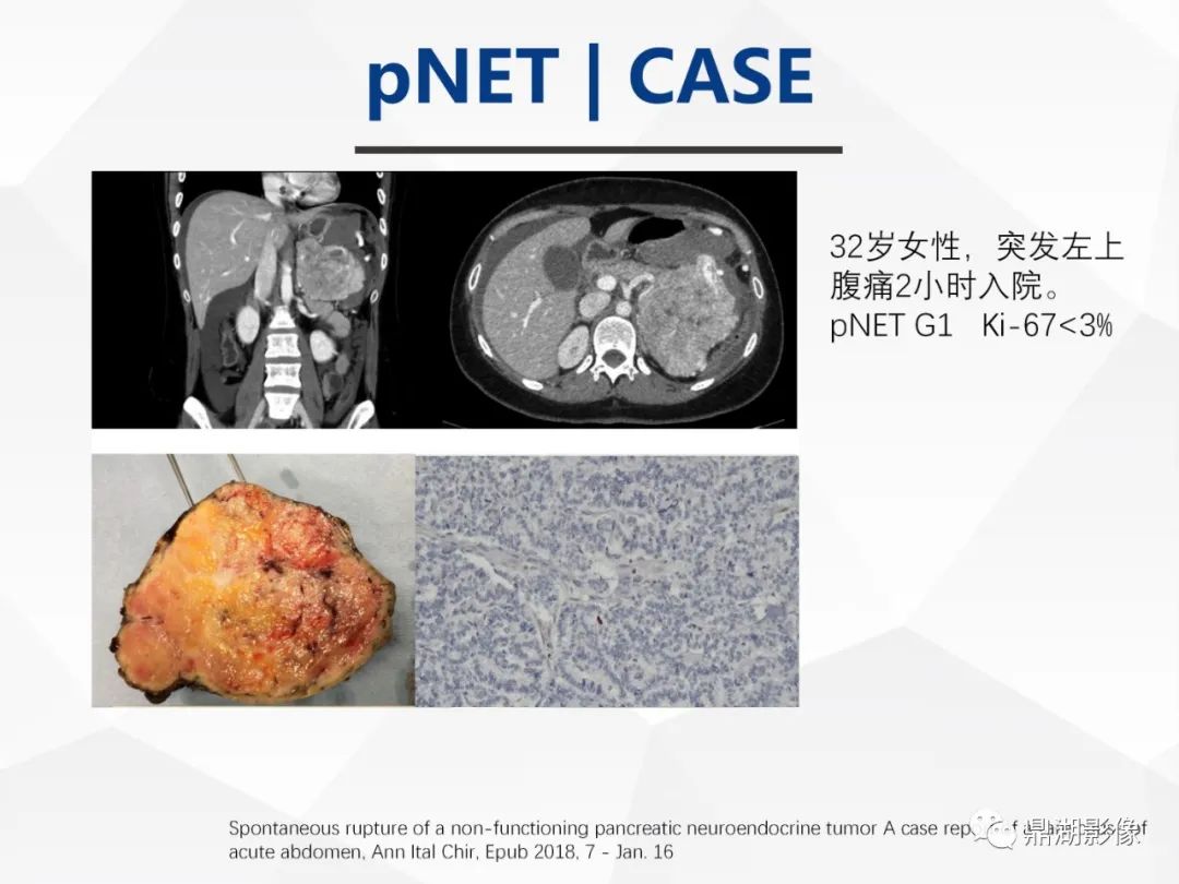 影像PPT - 【病例】胰腺神经内分泌肿瘤不典型病例1例CT及MR影像-29