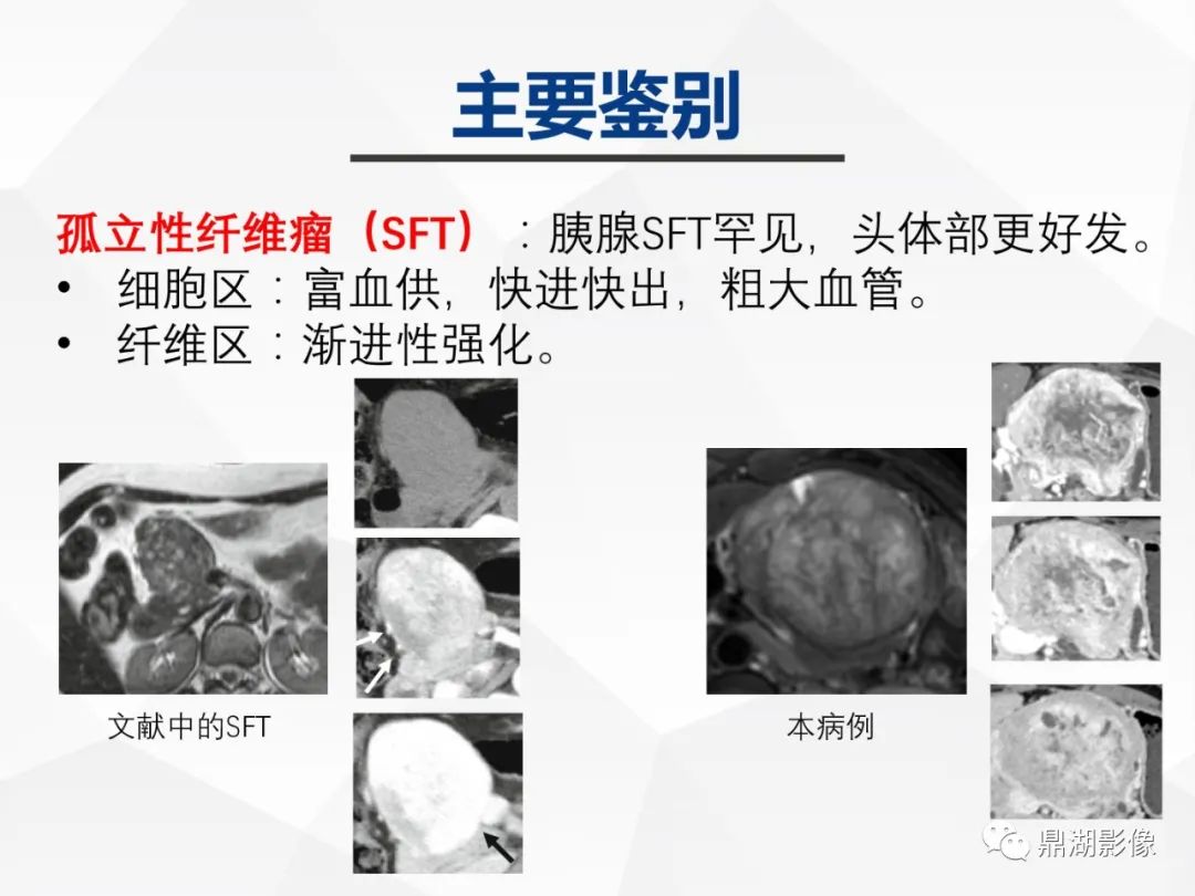 影像PPT - 【病例】胰腺神经内分泌肿瘤不典型病例1例CT及MR影像-30