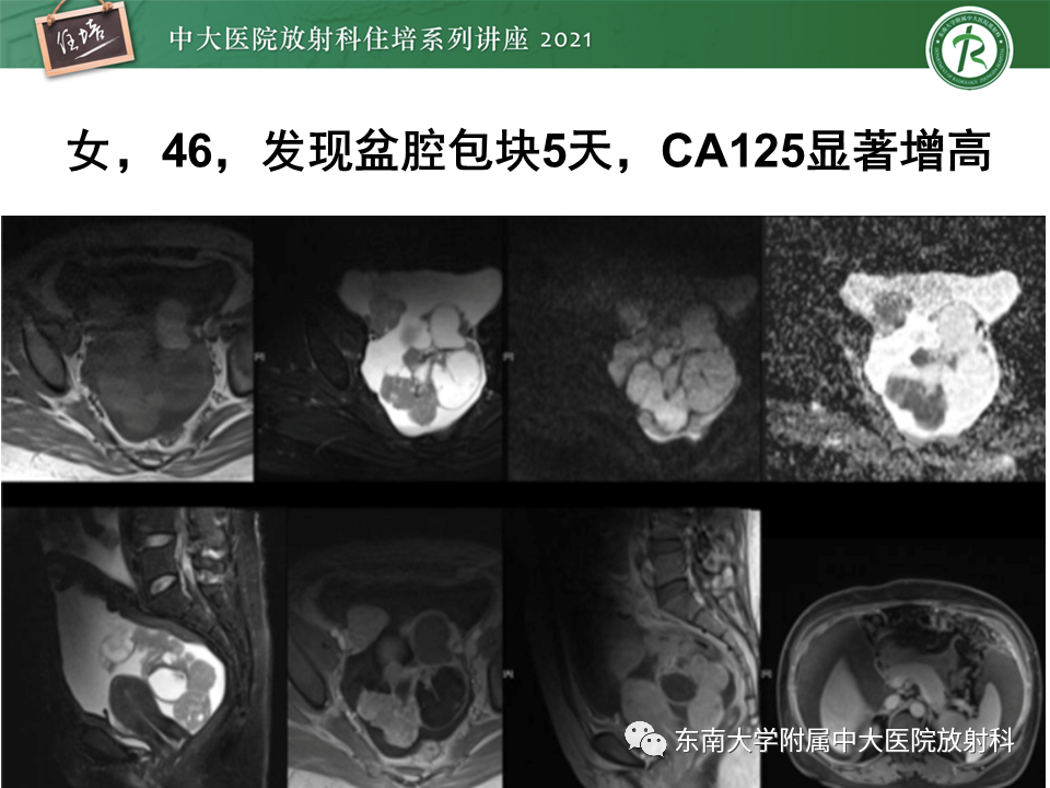 影像PPT - 【PPT】卵巢原发及继发粘液性肿瘤分析思路-5