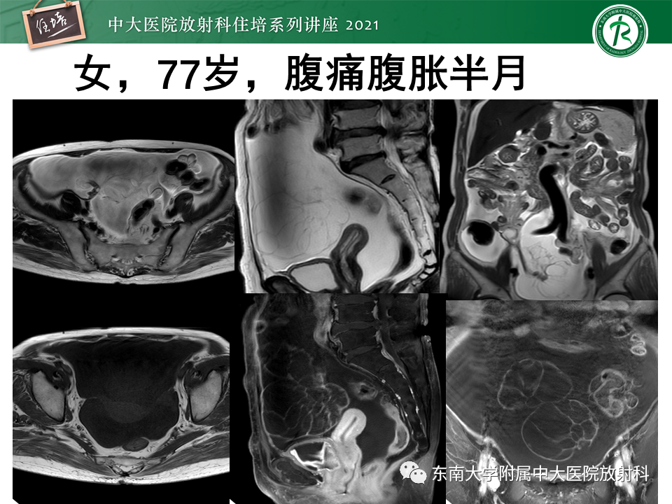影像PPT - 【PPT】卵巢原发及继发粘液性肿瘤分析思路-2