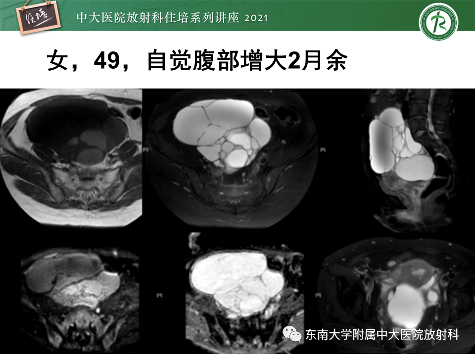 影像PPT - 【PPT】卵巢原发及继发粘液性肿瘤分析思路-6