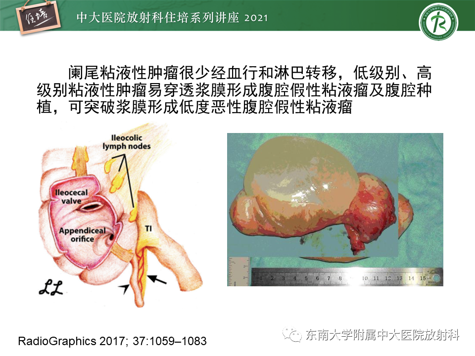 影像PPT - 【PPT】卵巢原发及继发粘液性肿瘤分析思路-14