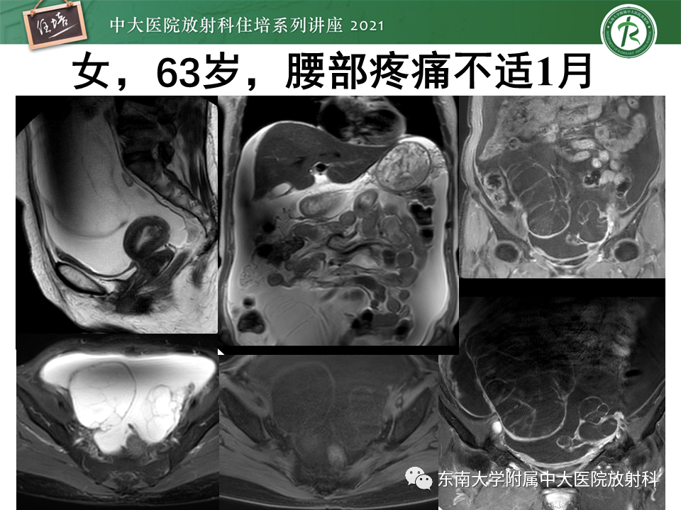 影像PPT - 【PPT】卵巢原发及继发粘液性肿瘤分析思路-15
