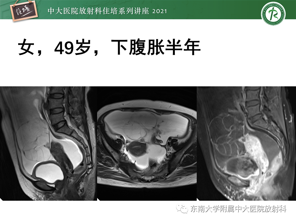 影像PPT - 【PPT】卵巢原发及继发粘液性肿瘤分析思路-23
