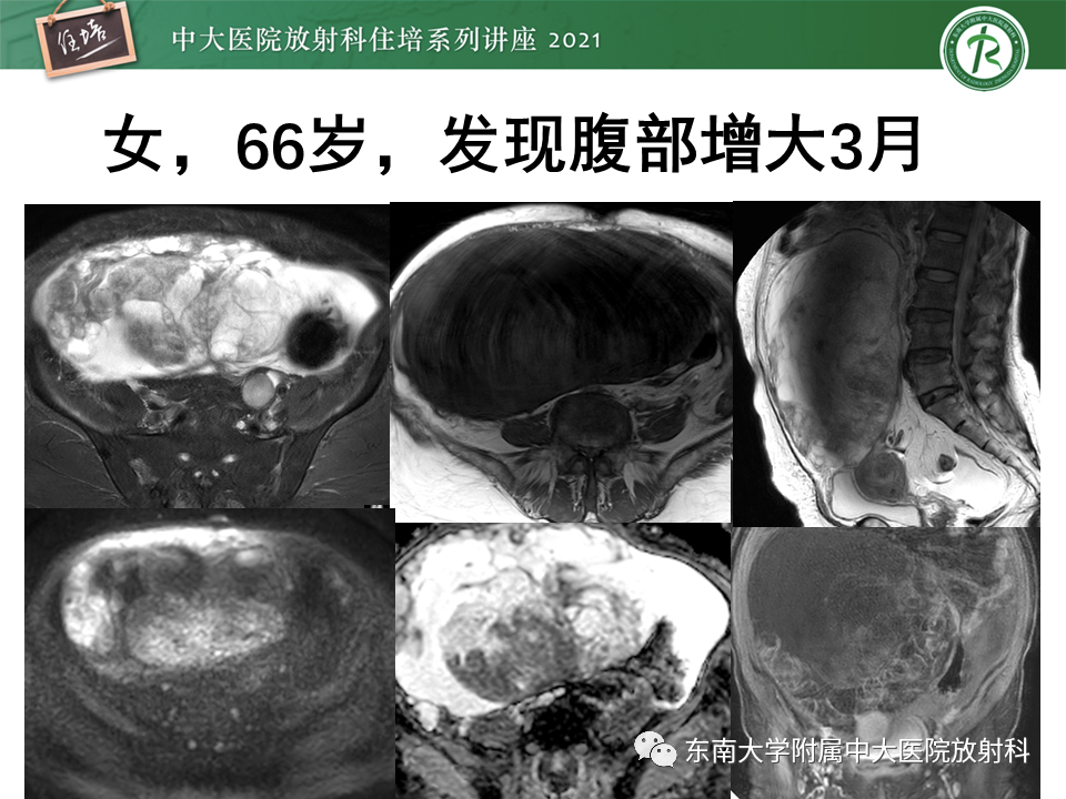 影像PPT - 【PPT】卵巢原发及继发粘液性肿瘤分析思路-18