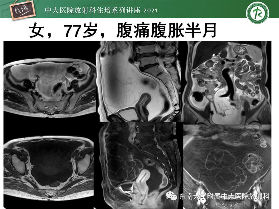 影像PPT - 【PPT】卵巢原发及继发粘液性肿瘤分析思路-26
