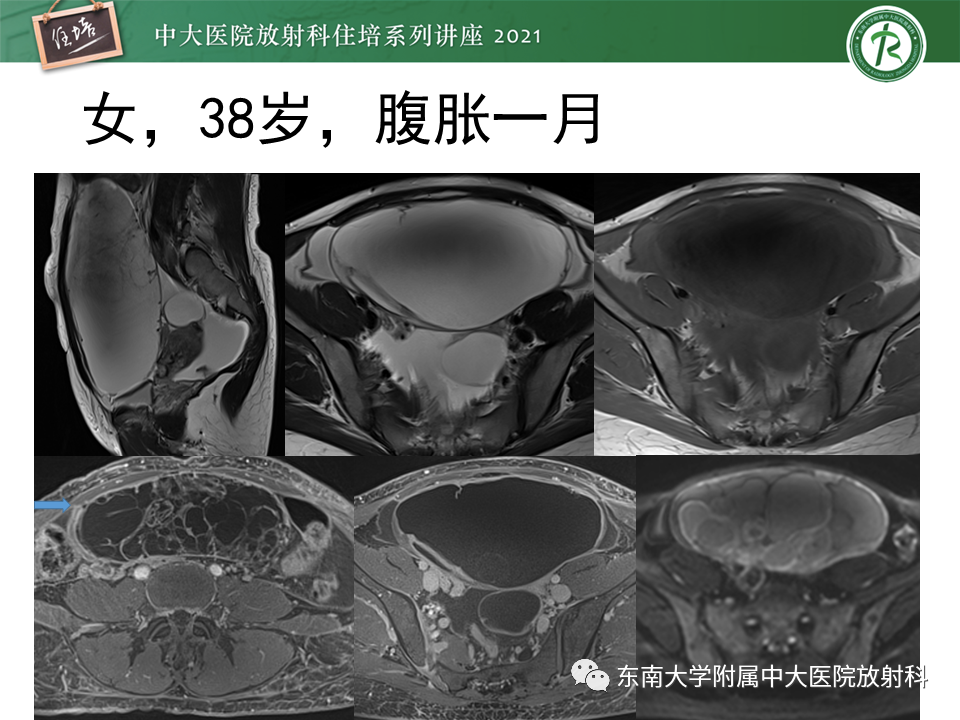 影像PPT - 【PPT】卵巢原发及继发粘液性肿瘤分析思路-29