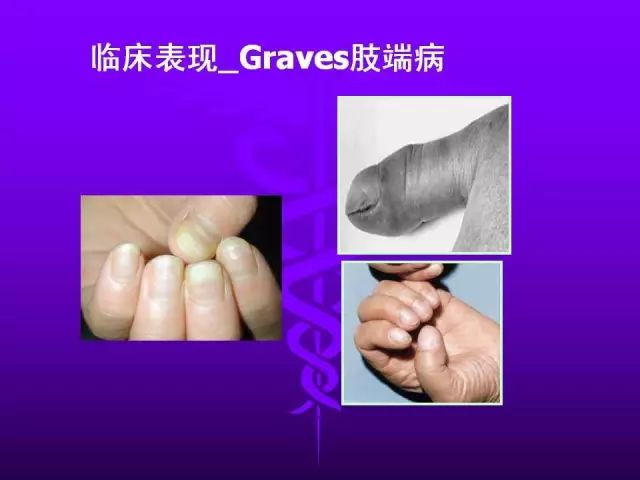 影像PPT - 11种常见代谢性骨病的影像学表现-75 影像PPT - 11种常见代谢性骨病的影像学表现-75