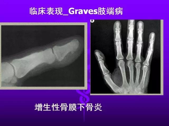 影像PPT - 11种常见代谢性骨病的影像学表现-74 影像PPT - 11种常见代谢性骨病的影像学表现-74