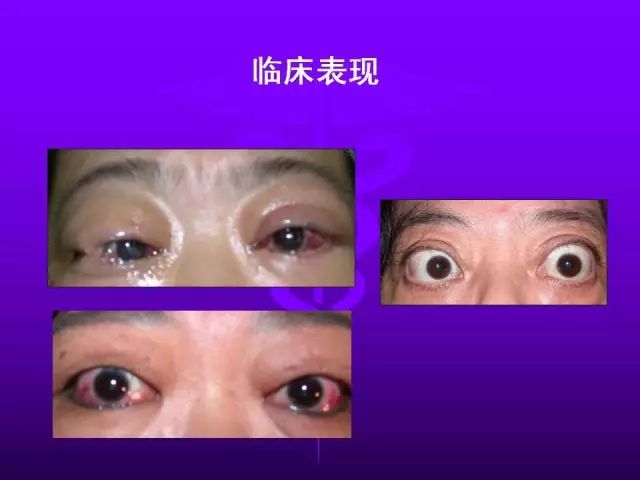 影像PPT - 11种常见代谢性骨病的影像学表现-87 影像PPT - 11种常见代谢性骨病的影像学表现-87