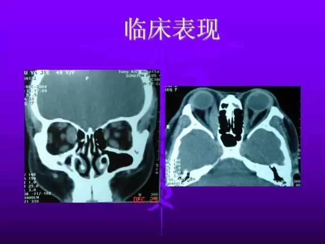 影像PPT - 11种常见代谢性骨病的影像学表现-90 影像PPT - 11种常见代谢性骨病的影像学表现-90