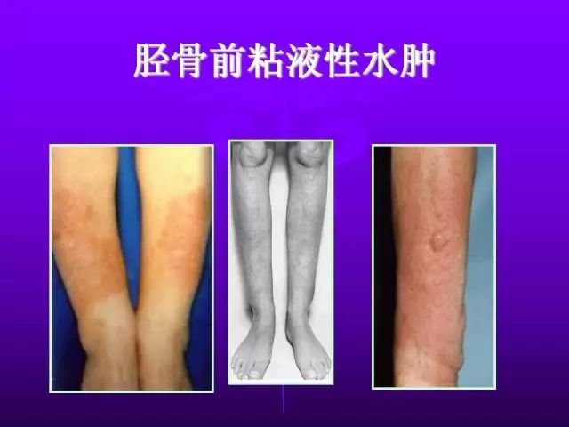 影像PPT - 11种常见代谢性骨病的影像学表现-92 影像PPT - 11种常见代谢性骨病的影像学表现-92