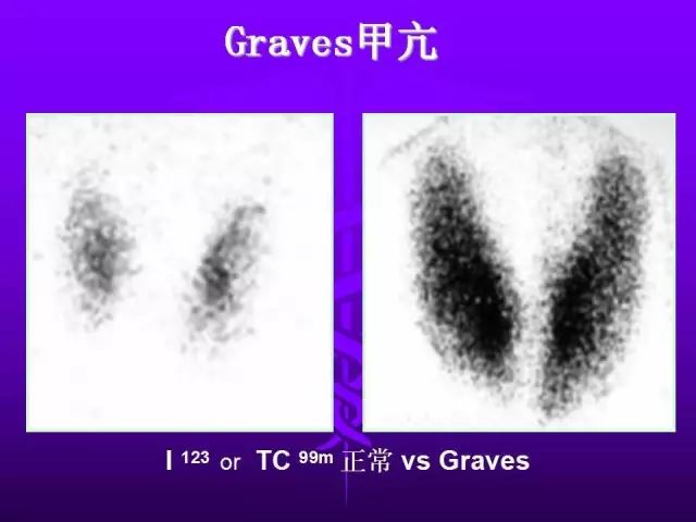影像PPT - 11种常见代谢性骨病的影像学表现-112 影像PPT - 11种常见代谢性骨病的影像学表现-112
