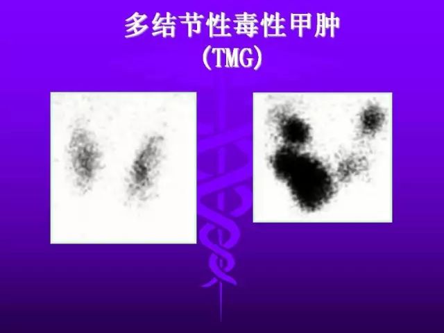 影像PPT - 11种常见代谢性骨病的影像学表现-114 影像PPT - 11种常见代谢性骨病的影像学表现-114