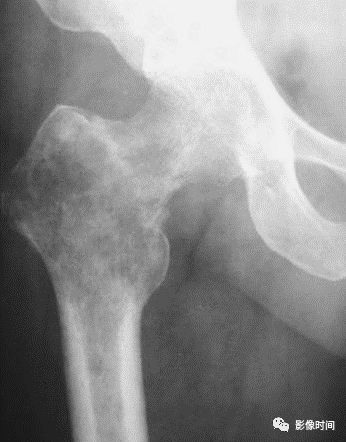 影像PPT - 骨肿瘤的9种基本影像表现-10