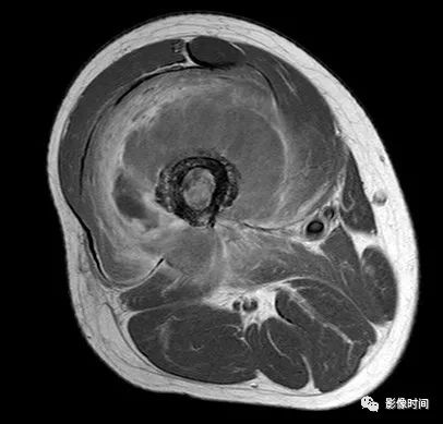 影像PPT - 骨肿瘤的9种基本影像表现-12