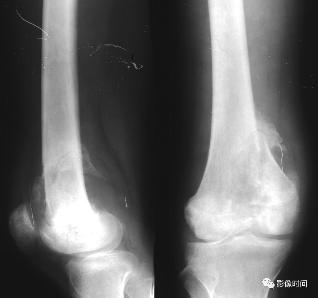 影像PPT - 骨肿瘤的9种基本影像表现-20