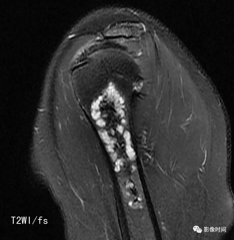 影像PPT - 骨肿瘤的9种基本影像表现-30