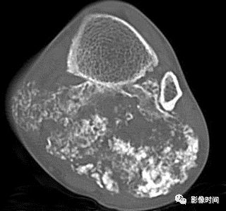 影像PPT - 骨肿瘤的9种基本影像表现-47