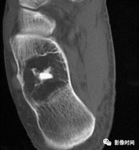 影像PPT - 骨肿瘤的9种基本影像表现-51