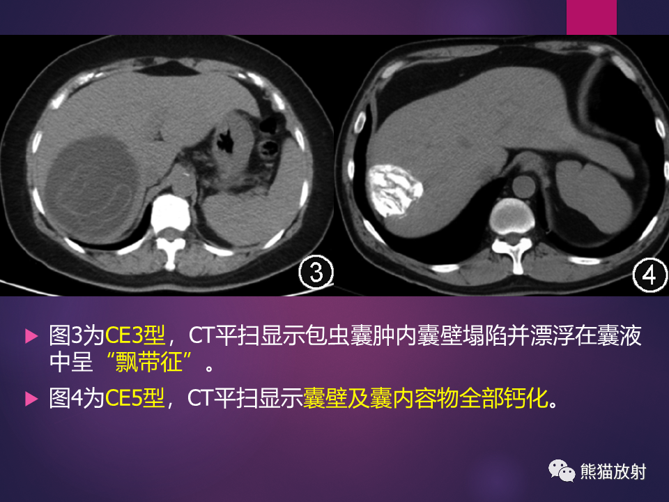 影像PPT - 【PPT】肝包虫病的影像学诊断专家共识-12