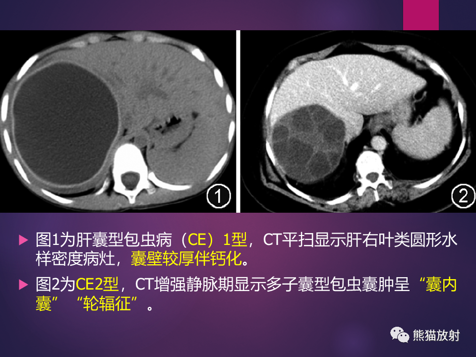 影像PPT - 【PPT】肝包虫病的影像学诊断专家共识-11