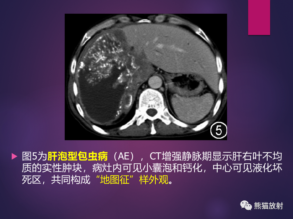 影像PPT - 【PPT】肝包虫病的影像学诊断专家共识-15