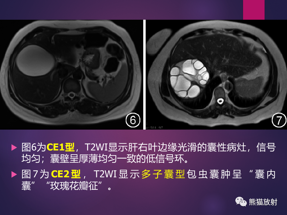 影像PPT - 【PPT】肝包虫病的影像学诊断专家共识-18