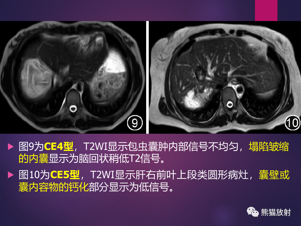 影像PPT - 【PPT】肝包虫病的影像学诊断专家共识-20