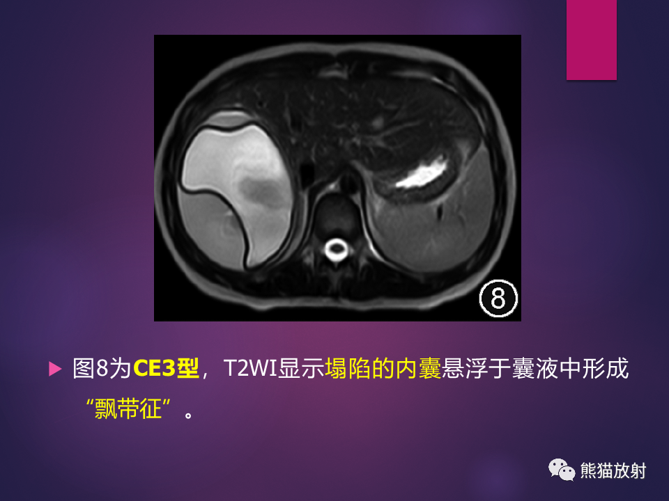 影像PPT - 【PPT】肝包虫病的影像学诊断专家共识-19