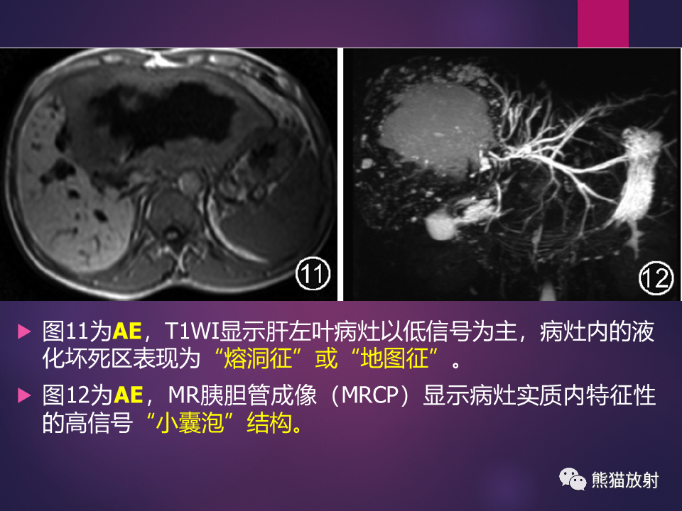 影像PPT - 【PPT】肝包虫病的影像学诊断专家共识-22