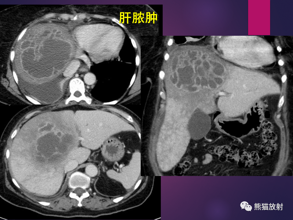 影像PPT - 【PPT】肝包虫病的影像学诊断专家共识-27