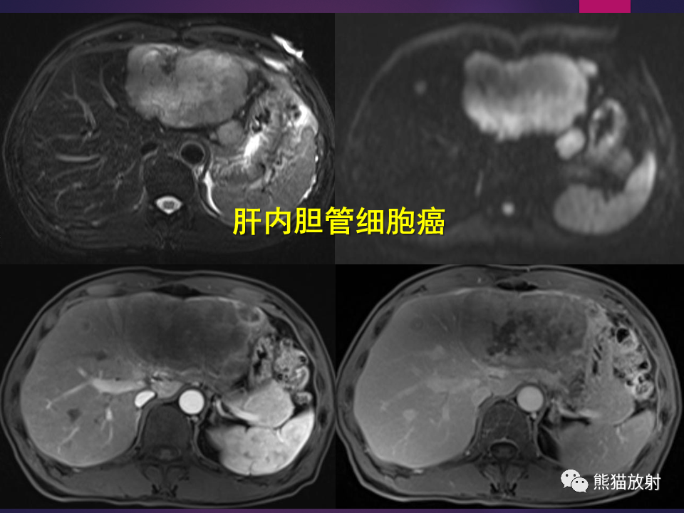 影像PPT - 【PPT】肝包虫病的影像学诊断专家共识-29