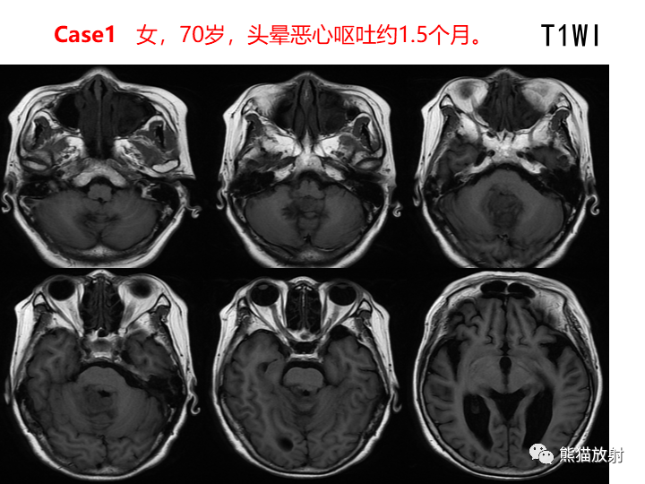 影像PPT - 【病例】小脑原发性脑淋巴瘤2例MR-2
