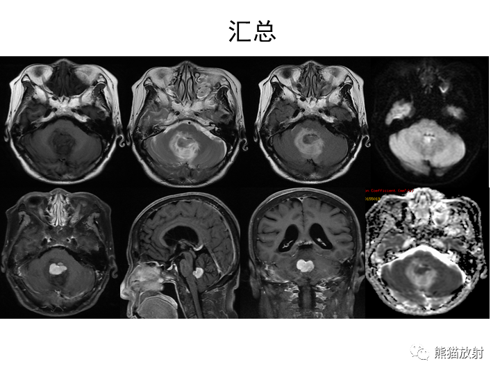 影像PPT - 【病例】小脑原发性脑淋巴瘤2例MR-7