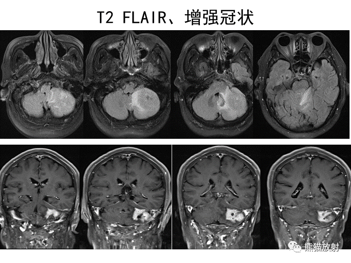 影像PPT - 【病例】小脑原发性脑淋巴瘤2例MR-11