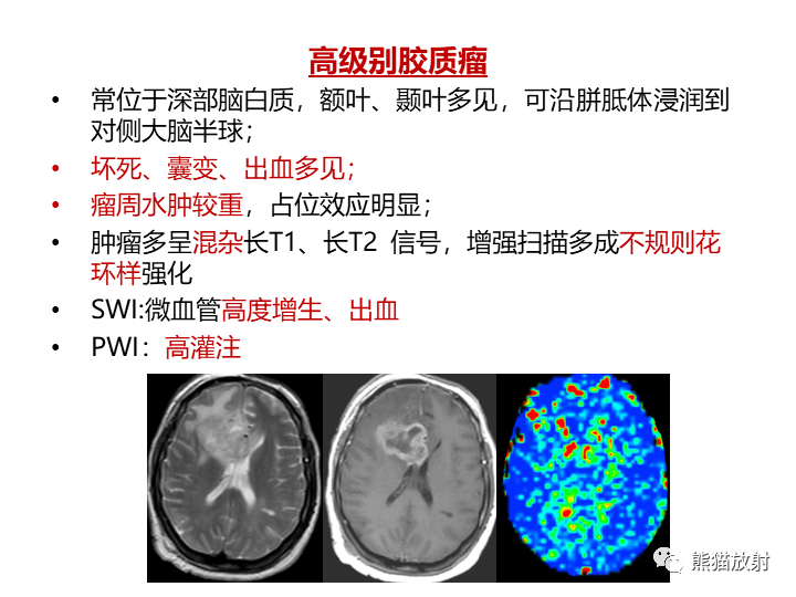 影像PPT - 【病例】小脑原发性脑淋巴瘤2例MR-25
