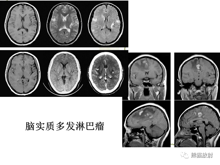 影像PPT - 【病例】小脑原发性脑淋巴瘤2例MR-22