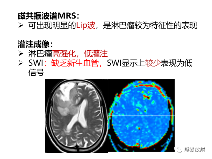 影像PPT - 【病例】小脑原发性脑淋巴瘤2例MR-23
