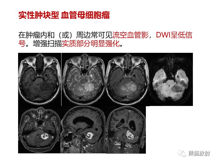 影像PPT - 【病例】小脑原发性脑淋巴瘤2例MR-26
