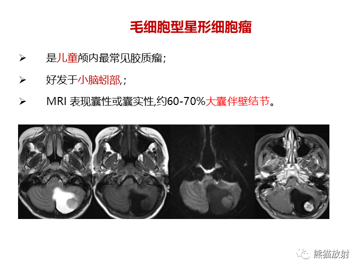 影像PPT - 【病例】小脑原发性脑淋巴瘤2例MR-28