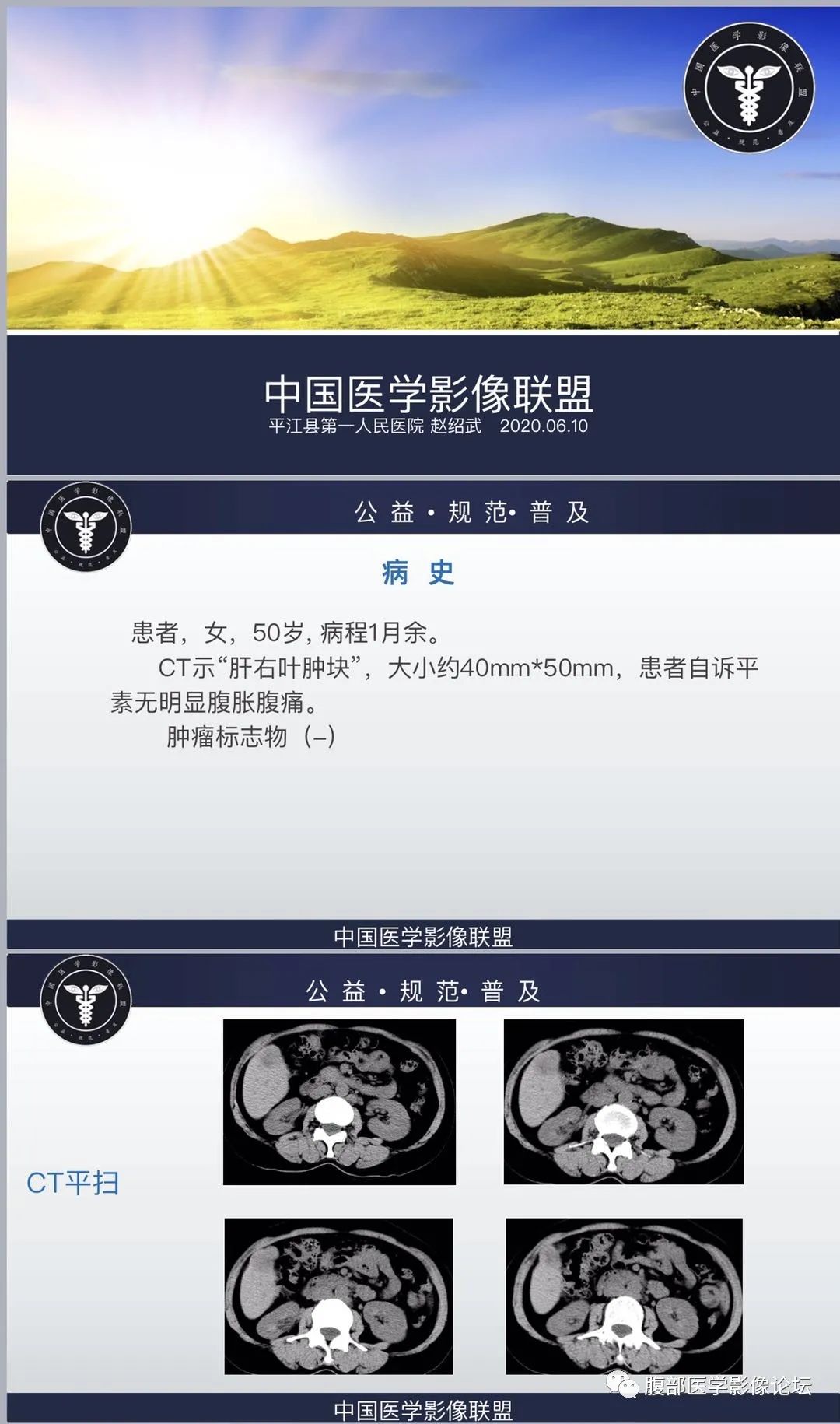 影像PPT - 【病例】低分化小细胞型肝细胞肝癌1例CT-1