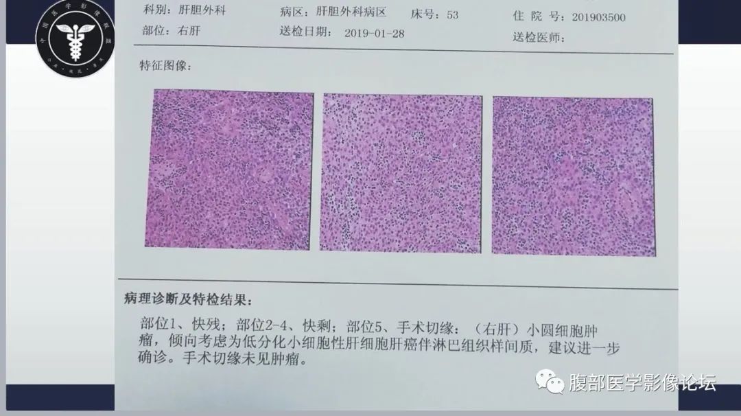 影像PPT - 【病例】低分化小细胞型肝细胞肝癌1例CT-3